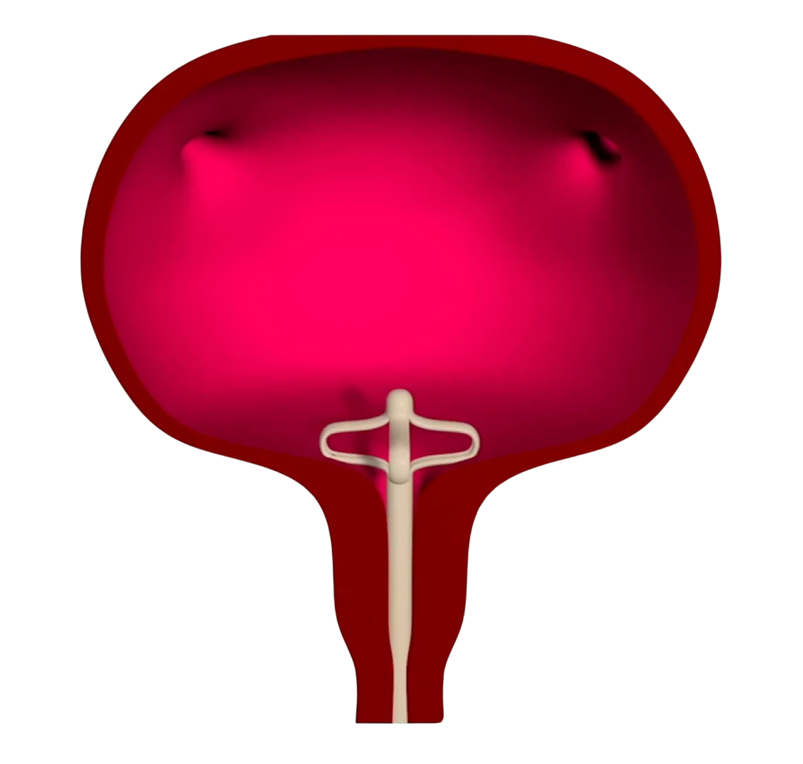 Lotus catheter draining the bladder almost completely